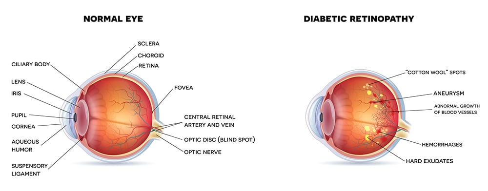 View of Normal Eye and Diabetic Retinopathy
